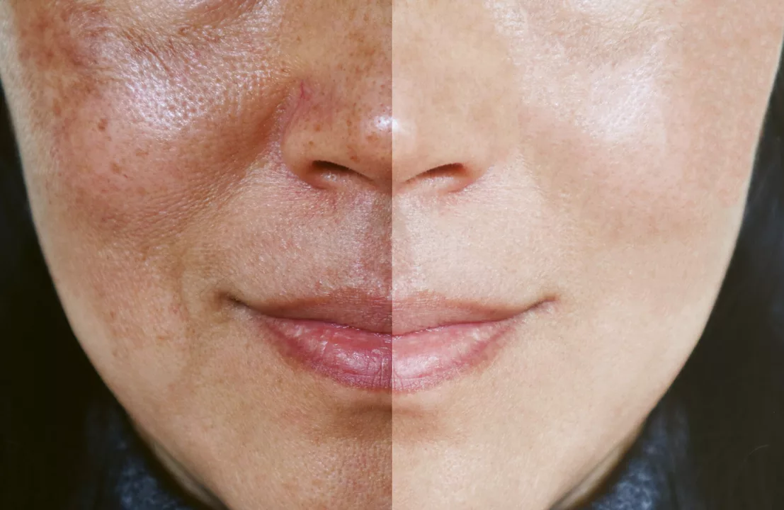Acide azélaïque pour la régénération de la peau : comment il peut aider à restaurer la vitalité juvénile